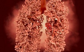 Dấu hiệu minh chứng ung thư phổi thời kì đầu