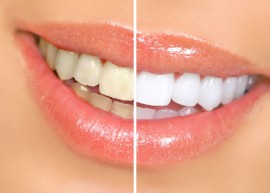 10 cách đơn giản làm trắng răng tại nhà