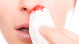Chảy máu mũi – tình trạng nguy hiểm của cơ thể