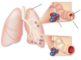 Những thực phẩm người ung thư phổi nên tránh