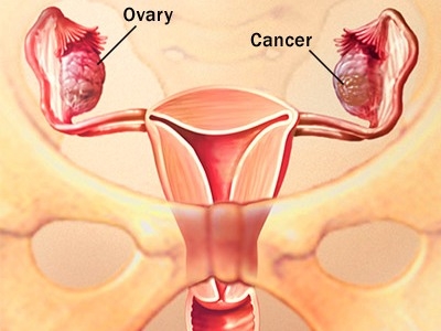 Nhận biết sớm 6 dấu hiệu ung thư buồng trứng