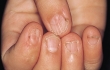 6 mẹo hay trị nấm móng