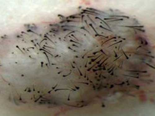 Chữa rụng tóc bằng tế bào gốc