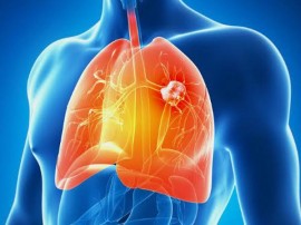 Những sai lầm về bệnh ung thư phổi