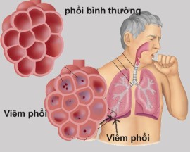 Các bệnh về phổi do ô nhiễm không khí