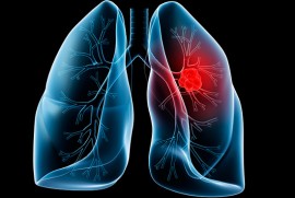 Ung thu phổi có thể nằm ẩn trong cơ thể hơn 20 năm