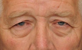  Bệnh về mắt thường gặp ở người già.