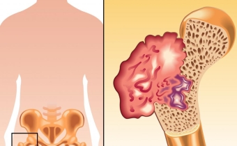 Triệu chứng ban đầu của ung thư xương