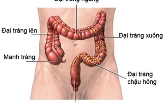 Ung thư trực tràng bắt đầu xuất hiện ở tuổi 20