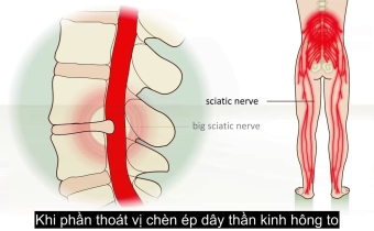 Dấu hiệu nhận biết thoát vị đĩa đệm