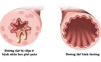 Nguyên nhân gây nên bệnh hen phế quản