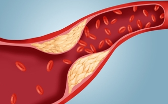 Cholesterol là gì?