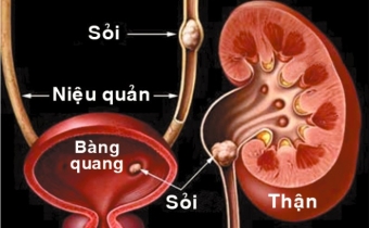 Những liệu pháp dinh dưỡng để loại trừ bệnh sỏi thận