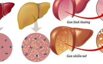 Thực phẩm bệnh nhân gan nhiềm mỡ cần tránh gấp