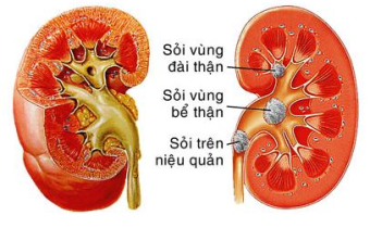 “Chuyện ấy” đều đặn có thể trị sỏi thận