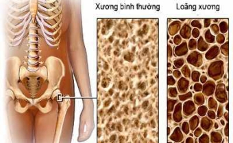 Đối phó với chứng đau nhứt xương khớp