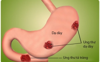 6 điều quan trọng về viêm loét dạ dày ai cũng cần biết