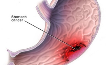 Dấu hiệu của bệnh ung thư dạ dày
