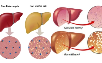 Gan nhiễm mỡ và chế độ ăn