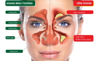 Viêm xoang: Làm gì để trị dứt điểm?